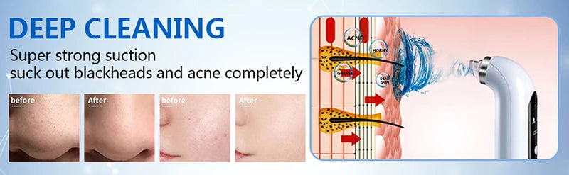 Aspirateur électrique pour pores